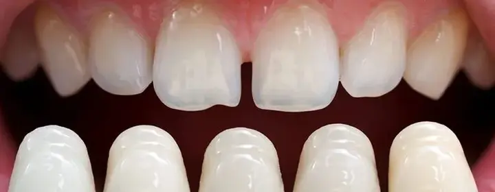 Porcelain Veneers